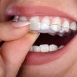 Teeth Grinding (Bruxism) Causes and Treatments