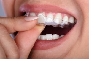 Teeth Grinding (Bruxism) Causes and Treatments