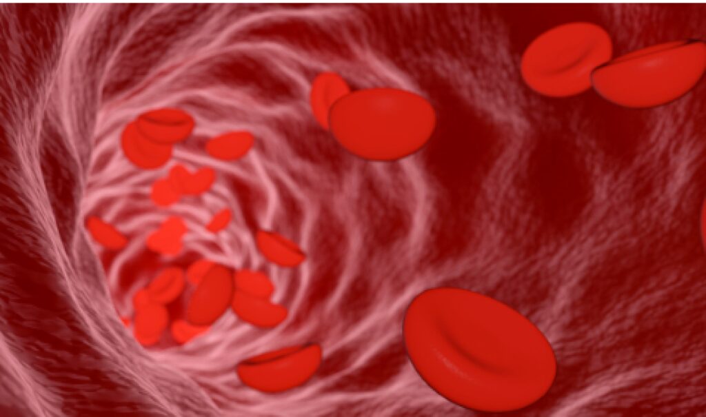 Low Hemoglobin Common Problem in Women